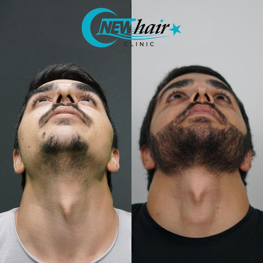 trapianto di barba con tecnica FUE